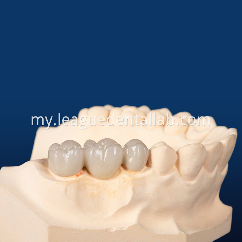 PFM,Metal crown,Fixed metal crown